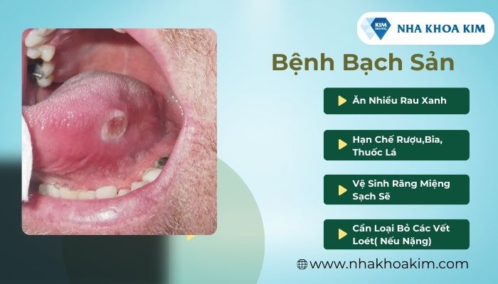 bệnh bạch sản ở lưỡi