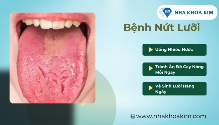 bệnh nứt lưỡi cũng là 1 trong các bệnh về lưỡi thường gặp
