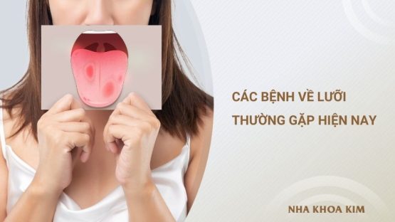 Các Bệnh Về Lưỡi Thường Gặp Hiện Nay