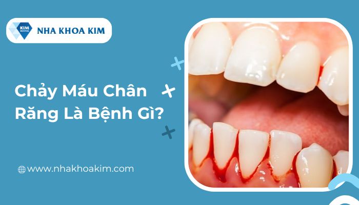Chảy máu chân răng là bệnh gì?
