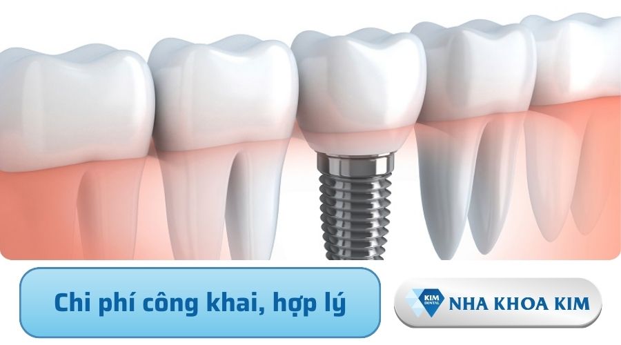 bảng giá công khai cũng là 1 trong những tiêu chí lựa chọn nha khoa uy tín để trồng răng implant