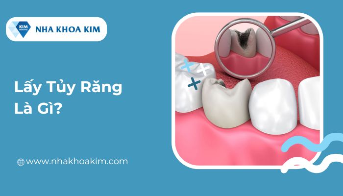 lấy tủy răng là gì?