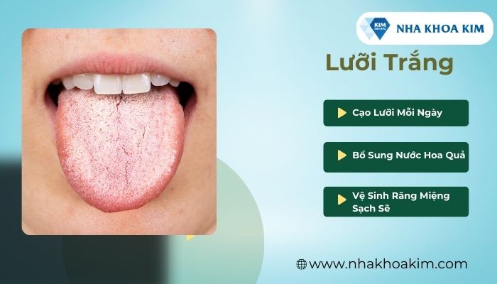 bệnh lưỡi trắng