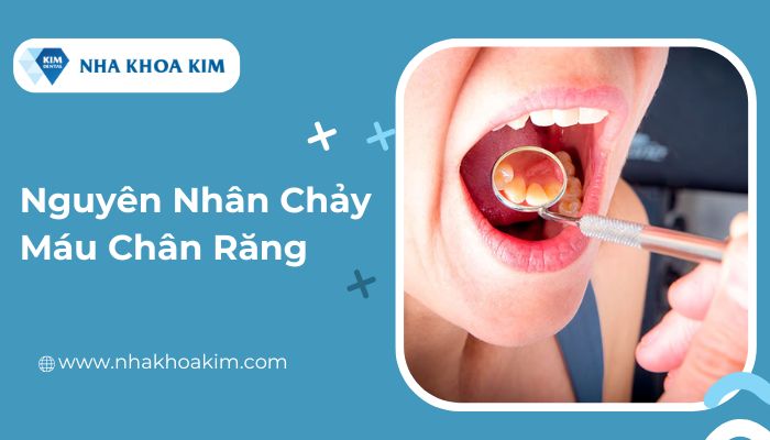 Nguyên nhân bị chảy máu chân răng 