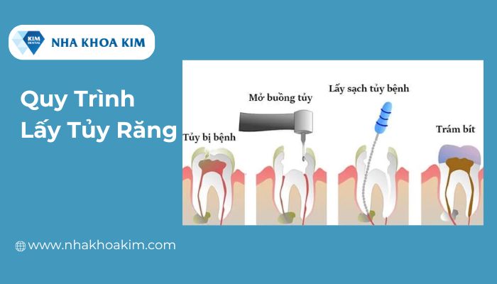 quy trình lấy tủy răng