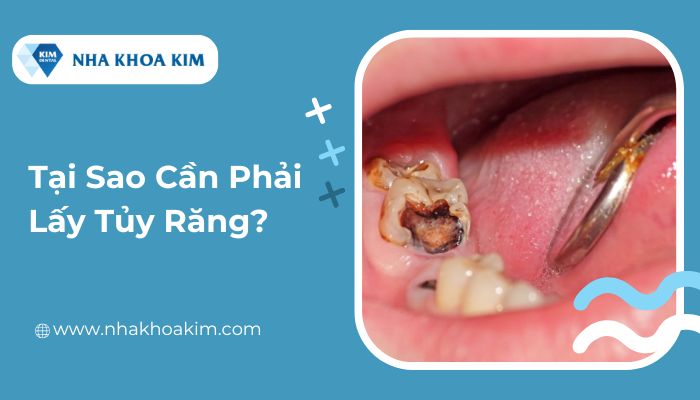 Tại sao phải lấy tủy răng?