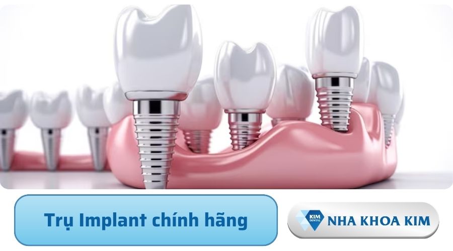sử dụng trụ implant chính hãng