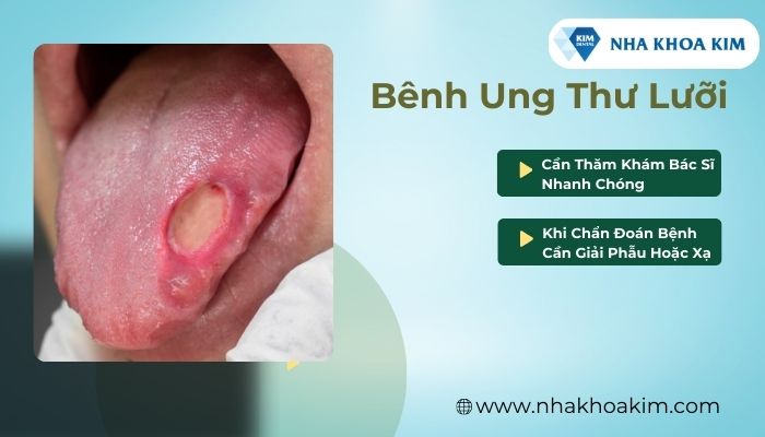 Ung thư lưỡi là trình trạng nặng nhất trong các bệnh về lưỡi