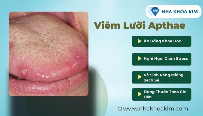 viêm lưỡi apthae