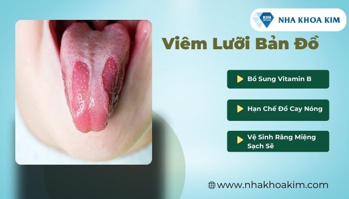 viêm lưỡi bản đồ