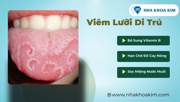 viêm lưỡi di trú là 1 trong các bệnh về lưỡi