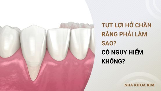 Tụt lợi hở chân răng phải làm sao? Có nguy hiểm không?