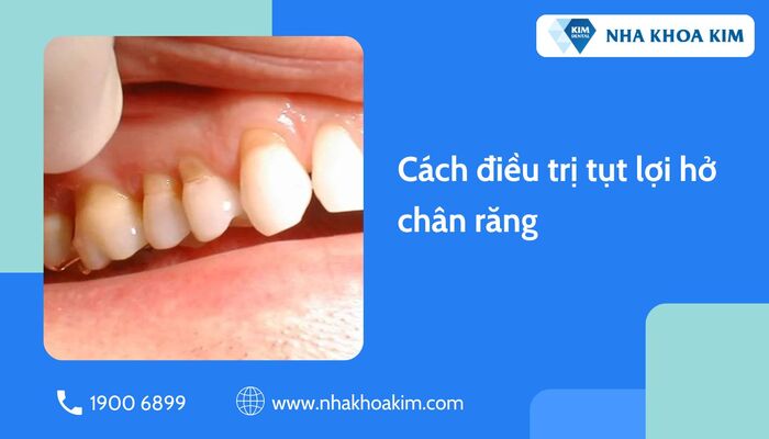 Cách điều trị tụt lợi hở chân răng