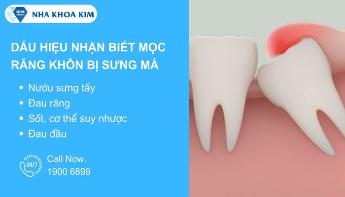 Dấu hiệu mọc răng không bị sưng má
