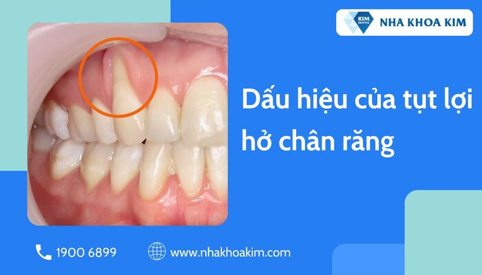 dấu hiệu tụt lợi hở chân răng