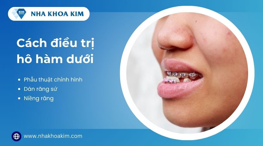 phương pháp điều trị hô hàm dưới