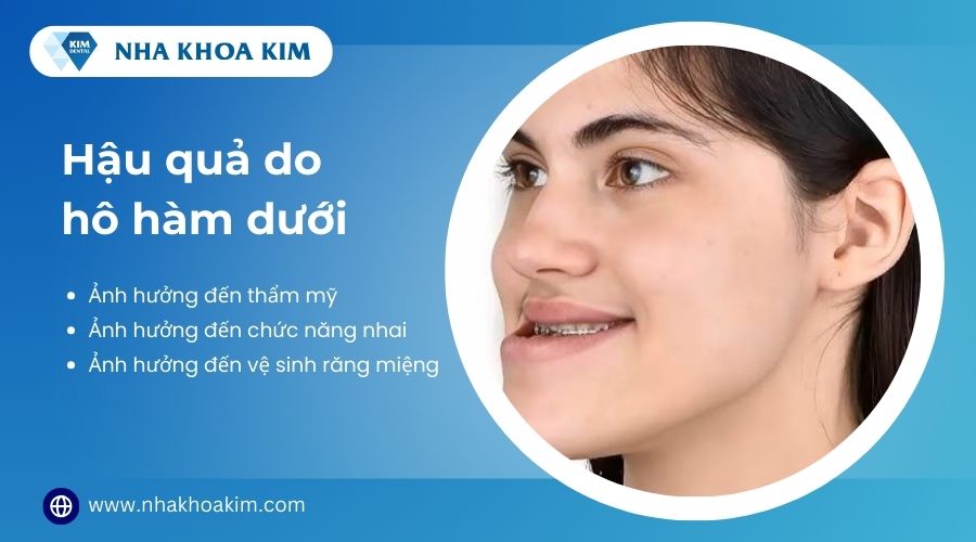 hậu quả do hô hàm dưới 