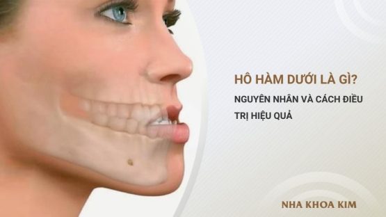 Hô hàm dưới là gì? Nguyên nhân và cách điều trị hiệu quả