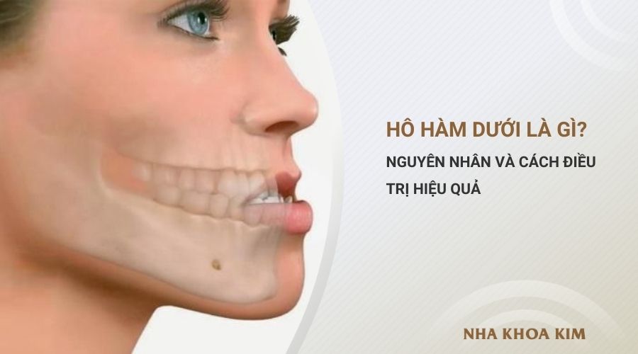 Hô hàm dưới là gì? Nguyên nhân và cách điều trị hiệu quả