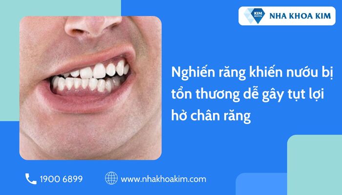 tụt lợi hở chân răng do nghiến răng