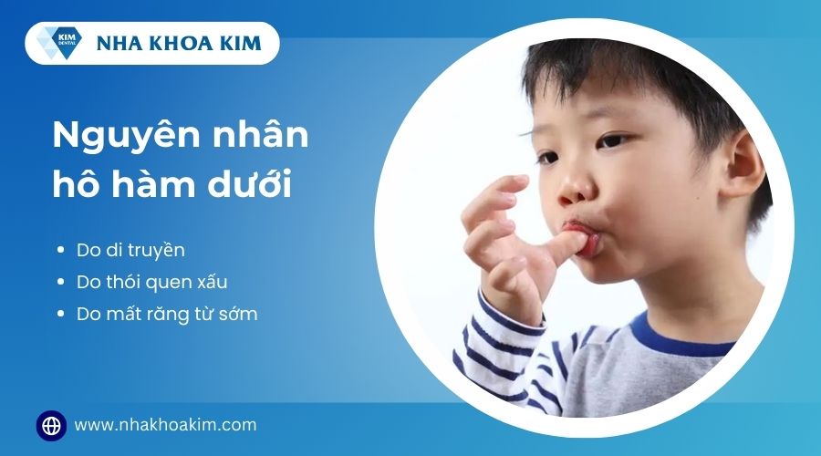 nguyên nhân khiến hàm dưới bị hô