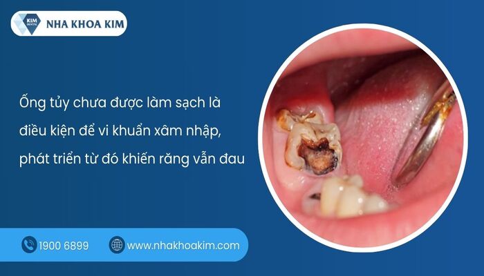 nguyên nhân răng lấy tủy rồi vẫn đau