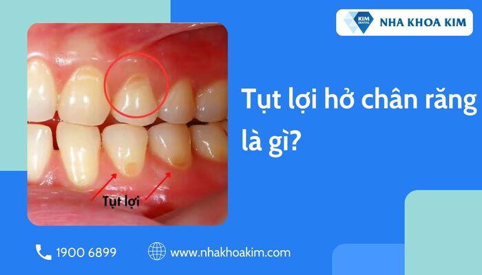 tụt lợi hở chân răng là gì?