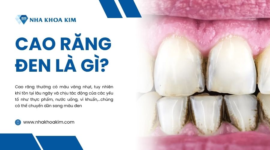 Cao răng màu đen là gì?