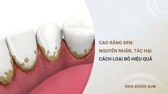 Cao răng đen: Nguyên nhân, tác hại và cách loại bỏ hiệu quả