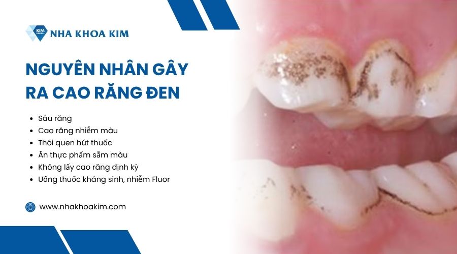 Nguyên nhân khiến cao răng bị đen