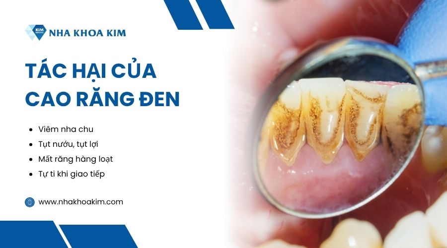 tác hại của cao răng có vết đen