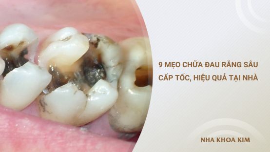 9 Mẹo chữa đau răng sâu cấp tốc, hiệu quả tại nhà