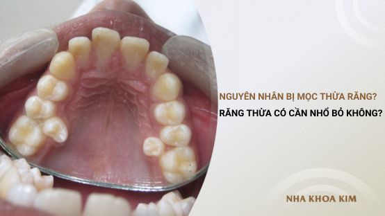 Nguyên nhân bị mọc thừa răng? Răng thừa có cần nhổ bỏ không?