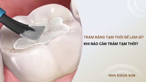 Trám răng tạm thời để làm gì? Khi nào cần trám tạm thời?