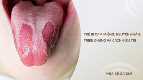 Trẻ bị cam miệng: Nguyên nhân, triệu chứng và cách điều trị