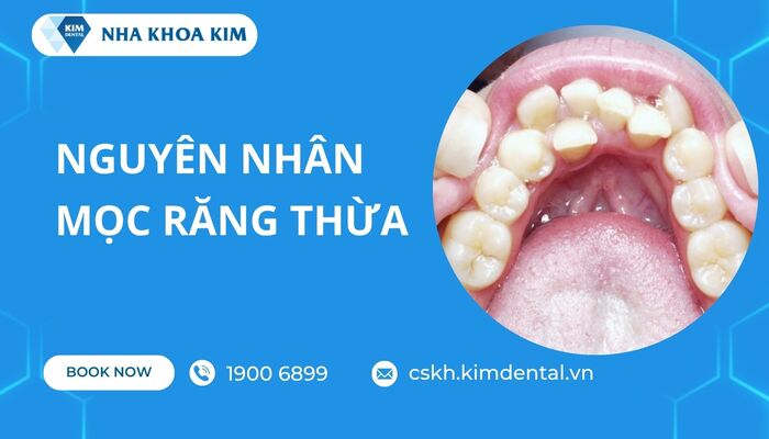 nguyên nhân răng bị mọc thừa