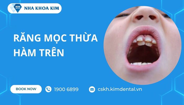 răng mọc dư thừa hàm trên