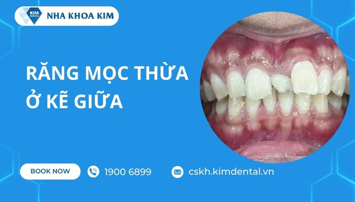 răng bị thừa mọc ở kẽ giữa 2 răng cửa