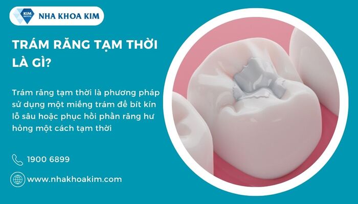 Trám răng tạm thời là gì?