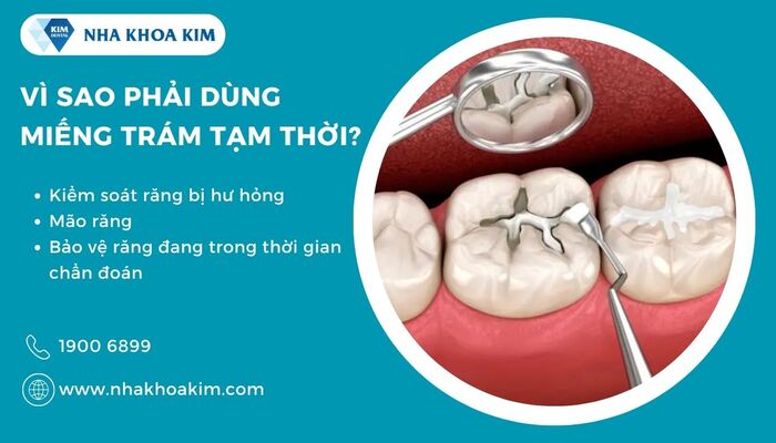 Vì sao phải trám răng tạm thời