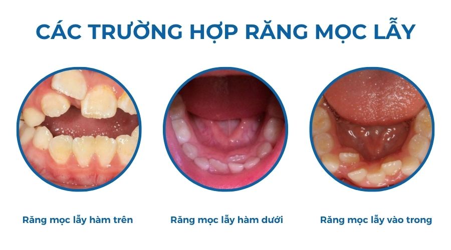 các trường hợp răng mọc lẫy