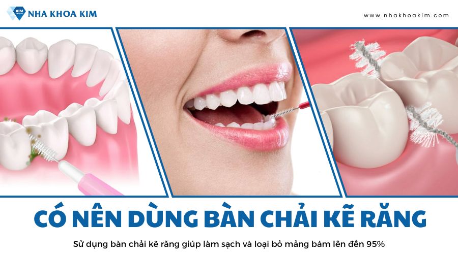 có nên cùng bàn chải kẽ răng