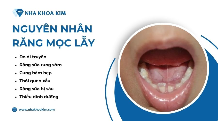 nguyên nhân răng mọc lẫy