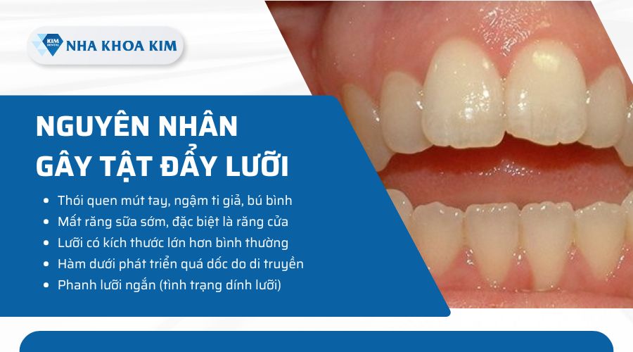 nguyên nhân tật đẩy lưỡi