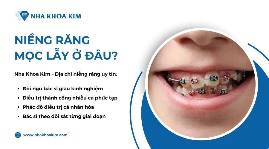 niềng răng mọc lẫy