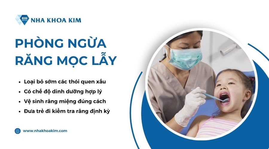 phòng ngừa răng mọc lẫy
