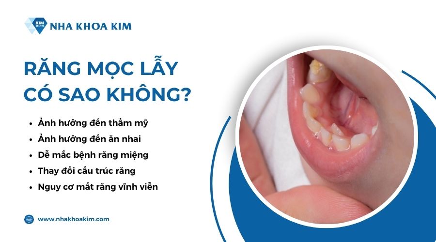 hậu quả khi răng bị lẫy