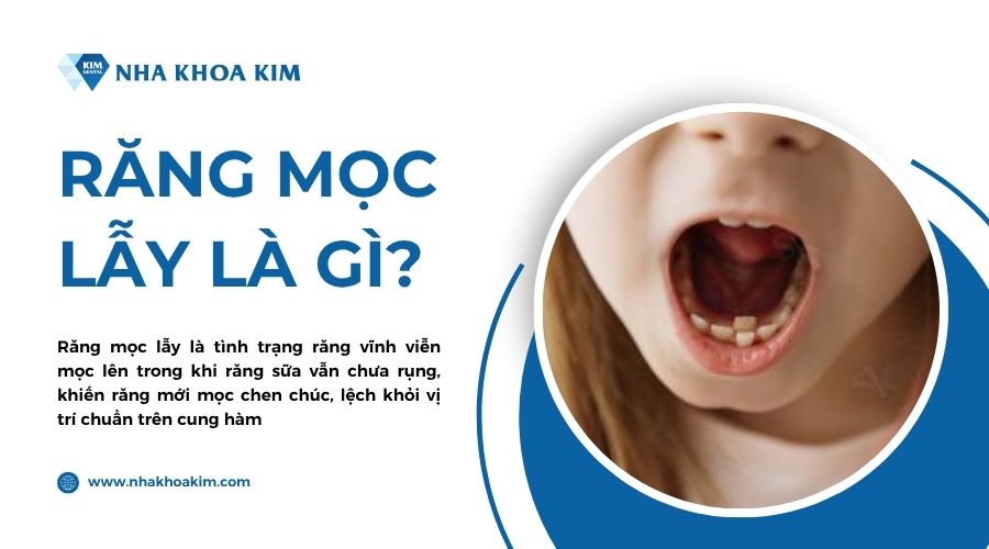 răng mọc lẫy là gì