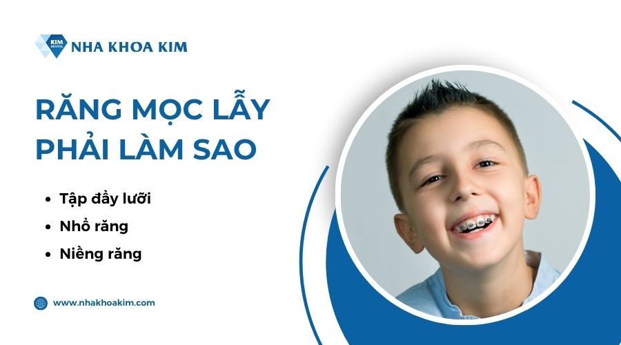 răng bị lẫy phải làm sao