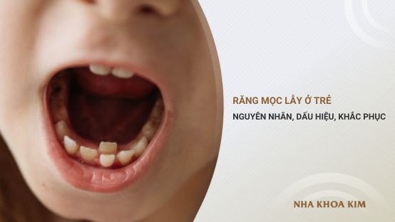 Răng mọc lẫy ở trẻ: Nguyên nhân, dấu hiệu và cách khắc phục